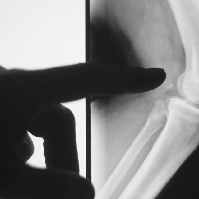 radiografía articulación